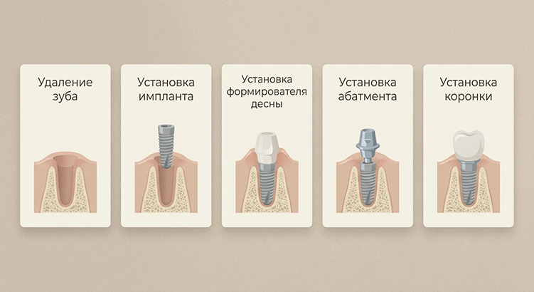 имплантация зубов Пермь