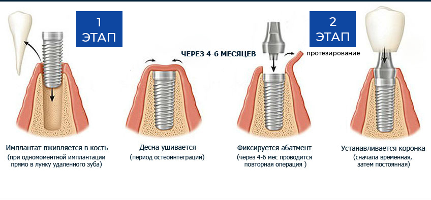 имплантация Пермь доступная цена Ваш Доктор